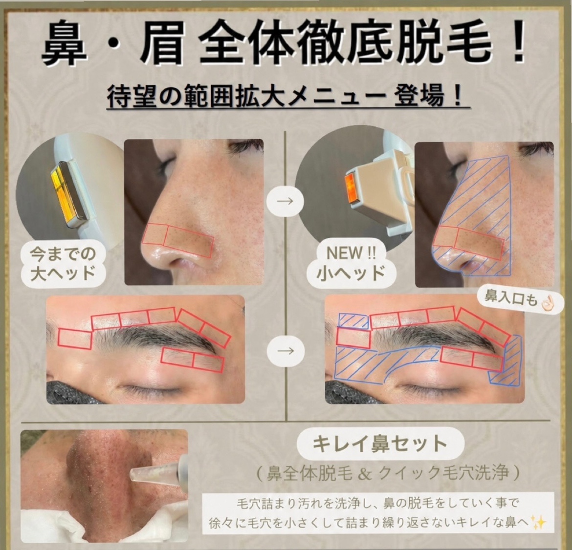 お仕事などで年中人前に露出されている腕や指の毛、夏に気になる足下・胸元の毛など 今ではお髭以外の箇所のニーズは一層高まり続けております。